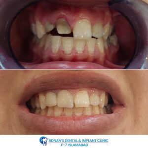 Adnan Dental Clinic Before And After Result